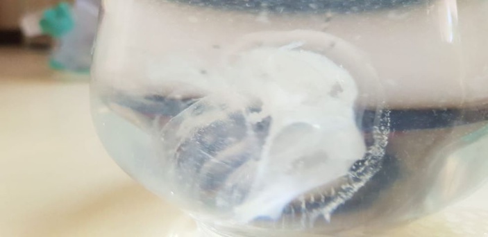 Un Zinfonaute piqué par une méduse à Roches Noires
