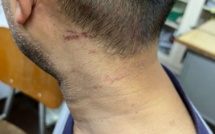 Arrestation d'Akil Bissessur : La police nie la brutalité policière, l'avocat publie des photos troublantes